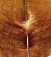 Anal fistula