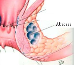 Anal Abscess