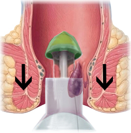 痔瘡槍環狀切除術圖片一
