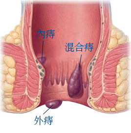 香港痔瘡專科_痔瘡的種類