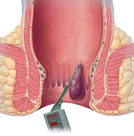 痔瘡溶解術