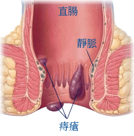 痔瘡治療