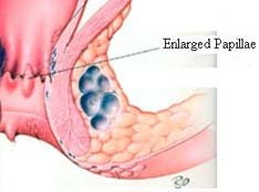 Enlarged Papillae