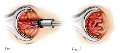 hemorrhoid treatment