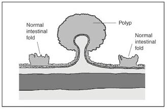 Colon Polyp