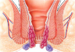 stapled hemorrhoidopexy treatment