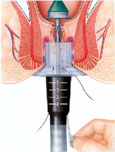 hemorrhoids pph close