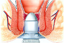 hemorrhoid PPH