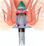 hemorrhoid pph knot