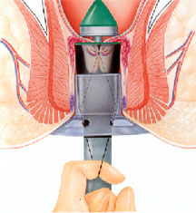 hemorrhoid pph pull mucosa