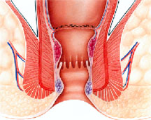 hemorrhoid pph staple