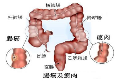 大腸癌