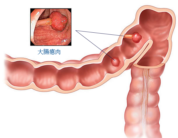 大肠瘜肉