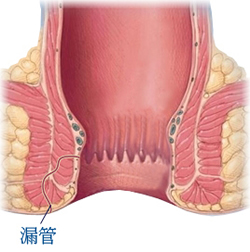 香港痔疮专科_廔管介绍