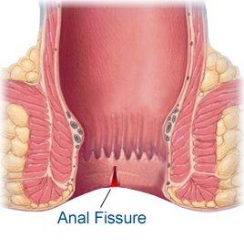 Anal fissure