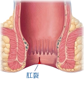 香港痔疮专科_甚麽是肛裂