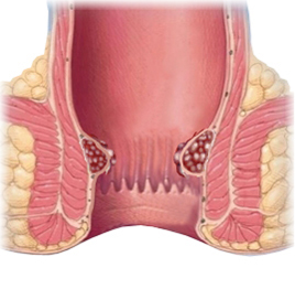 Internal hemorrhoids