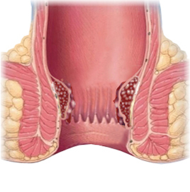 External hemorrhoids