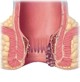 a prolapsed internal hemorrhoid