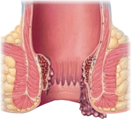 Thrombosed external hemorrhoid